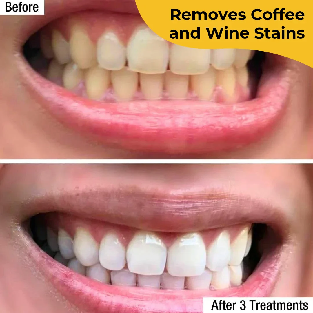 Teeth Whitening Strips - Image 5
