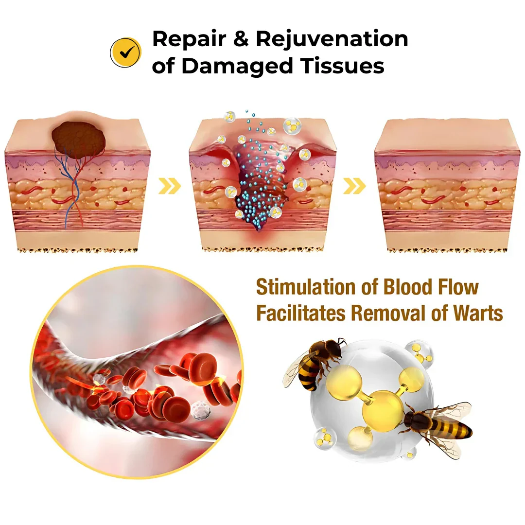 ELITEPRO™ Bee Venom Tag Remover Spray - 30ml : Eliminate Warts & Skin Tags Naturally in Just 1-2 Weeks! 🐝 - Image 3