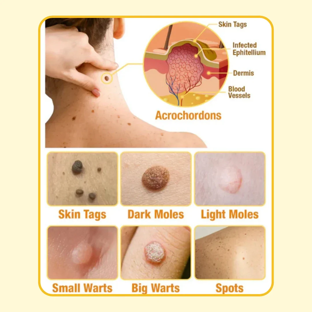 Pack of 2 ELITEPRO™ Bee Venom Tag Remover Spray - 30ml : Eliminate Warts & Skin Tags Naturally in Just 1-2 Weeks! 🐝 - Image 3