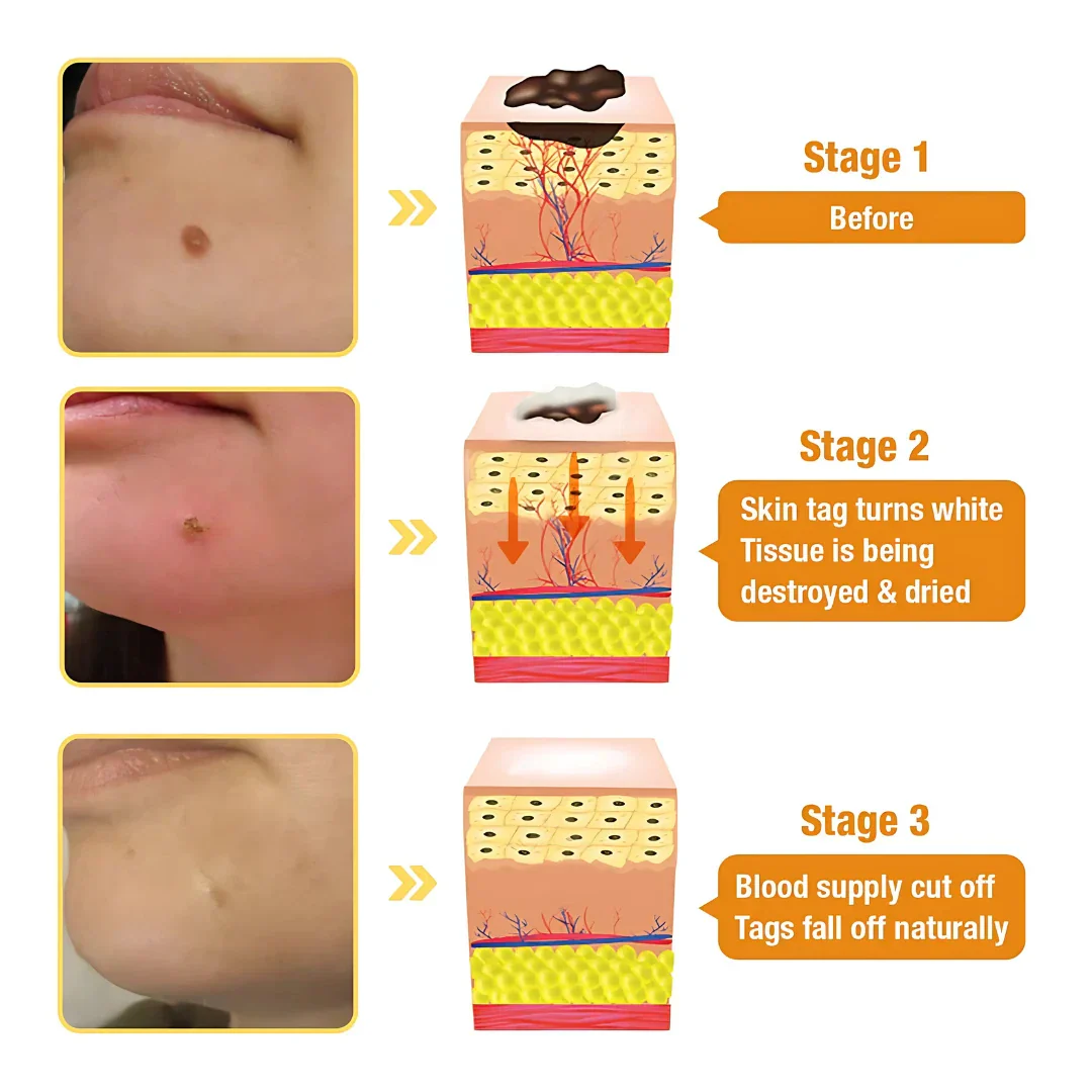 Pack of 2 ELITEPRO™ Bee Venom Tag Remover Spray - 30ml : Eliminate Warts & Skin Tags Naturally in Just 1-2 Weeks! 🐝 - Image 5