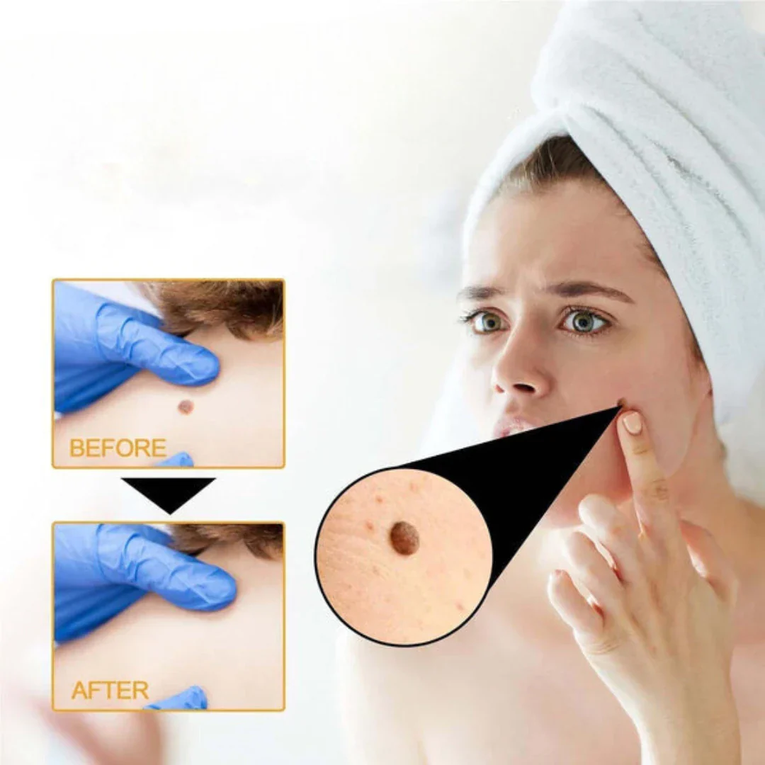 Pack of 2 ELITEPRO™ Bee Venom Tag Remover Spray - 30ml : Eliminate Warts & Skin Tags Naturally in Just 1-2 Weeks! 🐝 - Image 8